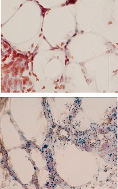 Myší tukové buňky po infekci bakterií Staphylococcus aureus. Nahoře normální, dole  ty, které antibakteriální protein neprodukují. Modré skvrnky představují bakterie (foto University of California v San Diegu).