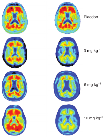 Zmenšení amyloidových usazenin v mozku během ročního podávání různých dávek aducanumabu i placeba (nahoře). Snímky byly pořízeny pozitronovou emisní tomografií. V levém sloupci vidíme stav před počátkem experimentu, v pravém po podání  14 dávek léčiva během jednoho roku (obr. J.sevigny et al., The antibody aducanumab reduces Aßamp;, Nature 537, 50–56, Sept.2016, doi:10.1038/nature19323).