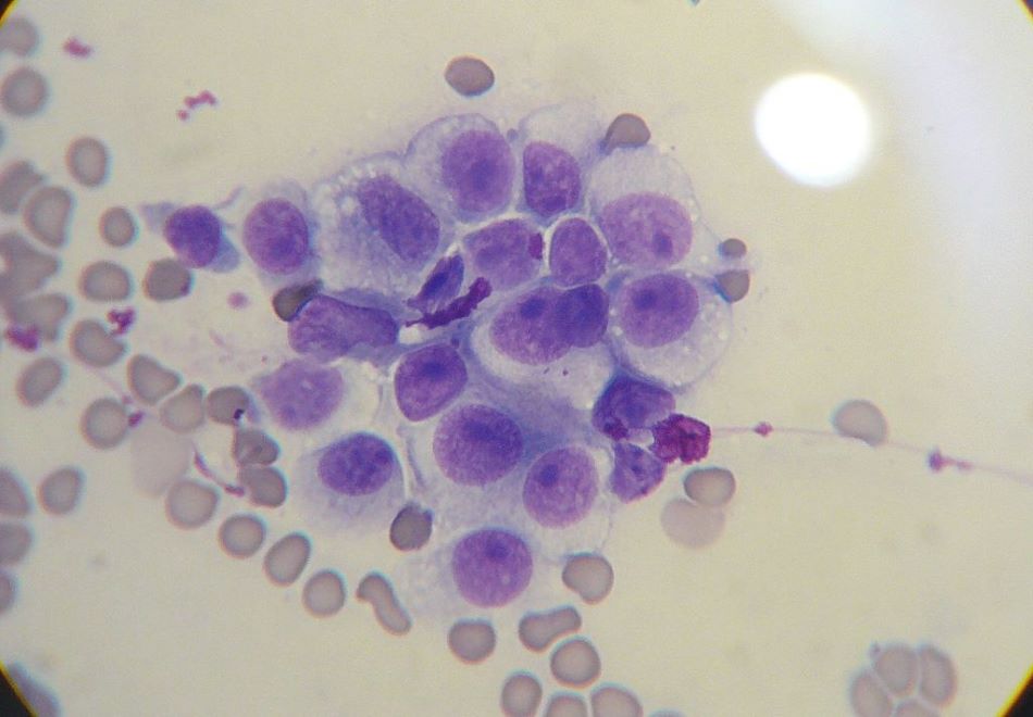 Mikroskopický snímek buněk CTVT obarvených modifikovaným Wrightovým barvivem, foto Joel Mills [CC BY-SA 3.0 (http://creativecommons.org/licenses/by-sa/3.0/)]