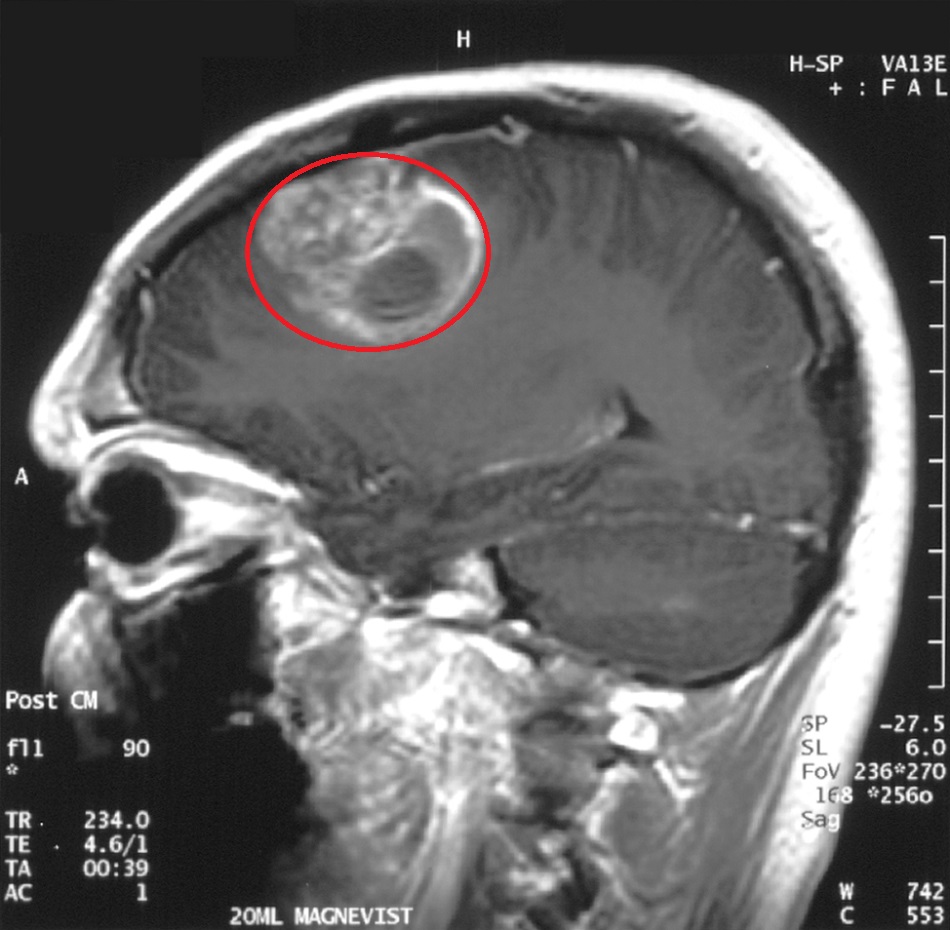 Glioblastom u patnáctiletého chlapce vidíme na snímku řezu lebkou pořízeném magnetickou rezonancí (Christaras A, CC-BY-SA-3.0, http://creativecommons.org/licenses/by-sa/3.0/, via Wikimedia Commons).