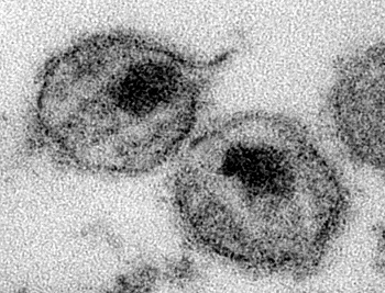 Viriony (virové částice) HIV. Jejich průměr činí přibližně 100 nm.  Snímek pořízen transmisním elektronovým mikroskopem, obr.Centers for Disease Control and Prevention/A. Harrison; Dr. P. Feorino, svolení PD-USGov-HHS-CDC.