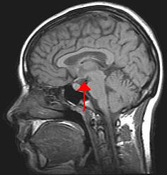 Polohu hypothalamu na řezu lidským mozkem označuje červená šipka (Wikimedia Commons).