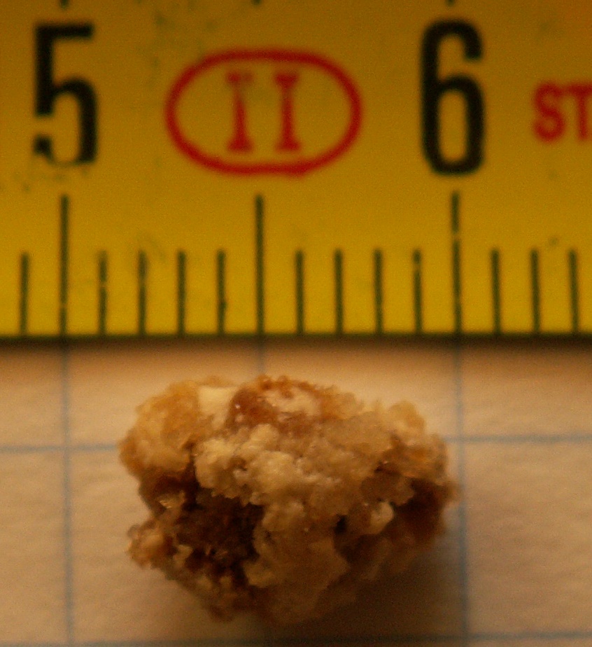 8 mm velký ledvinový kámen, foto Robert R. Wal, http://en.wikipedia.org/wiki/Kidney_stone, Public domain, via Wikimedia Commons.