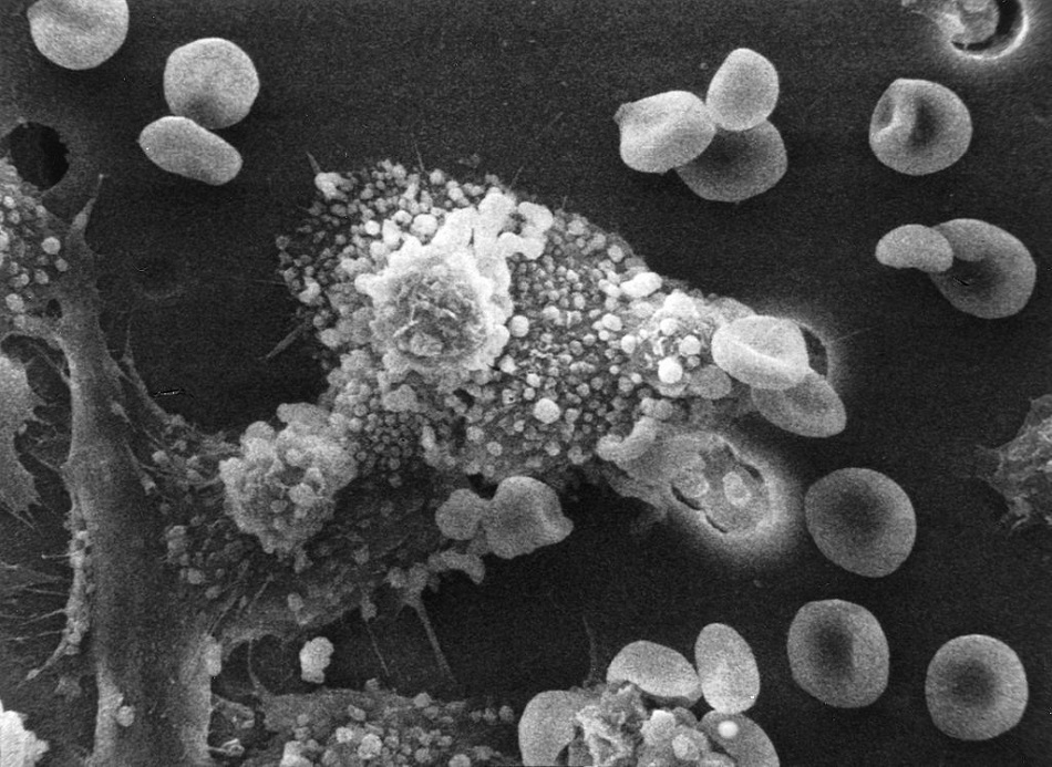 Makrofág ve středu obrázku pohlcuje rakovinné buňky. Promáčknuté oválné útvary kolem jsou červené krviny, foto Susan Arnold, volné dílo, via Wikimedia Commons.