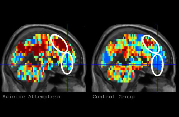 Vlevo zobrazení  mozku  člověka se sebevražednými sklony, vpravo mozek zdravý, pořízeno metodou funkční magnetické rezonance (M.A.Just et al., Machine learning of neural representations of suicide and emotion concepts identifies suicidal youth, Nature Human Behaviour, volume 1, pages 911–919 (2017), doi:10.1038/s41562-017-0234-y).