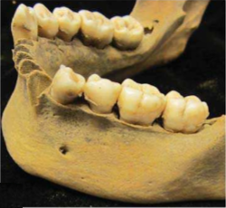 Nánosy zubního kamene na zubech spodní čelisti z hrobu označeného NF-95 (Andrew T.Ozga et al., Successful enrichment and recovery of whole mitochondrial genomes from ancient human dental calculus, Am. J. Phys. Anthropol., 16 Mar.2016, DOI: 10.1002/ajpa.22960).