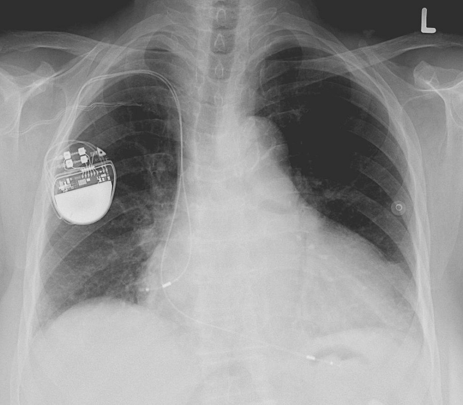 Rentgenový snímek hrudníku s běžným kardiostimulátorem (foto Lucien Monfils, GFDL 1.2, via Wikimedia Commons).