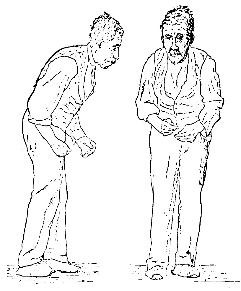 Ilustrace Parkinsonovy choroby z knihy „A Manual of Diseases of the Nervous System“ z roku 1886 od Sira Williama Richarda Gowerse, volné dílo via Wikimedia Commons.