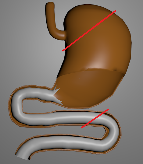 Plastový Endobarrier, který pokrývá vnitřní povrch část tenkého střeva bezprostředně za žaludkem. Červené čáry označují místo propojení při žaludečním bypassu.