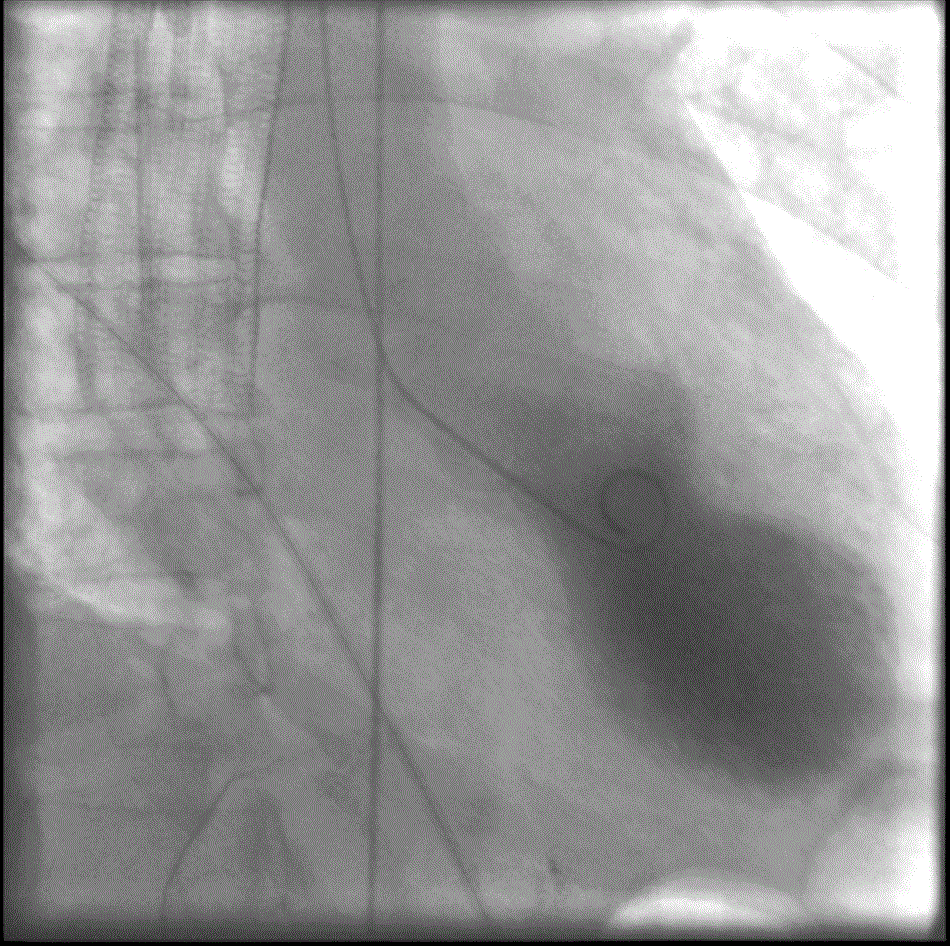 Typický tvar levé srdeční komory při stresové kardiomyopatii, (foto Tara C Gangadhar, Elisabeth Von der Lohe, Stephen G Sawada and Paul R Helft, CC BY 2.0, https://creativecommons.org/licenses/by/2.0).