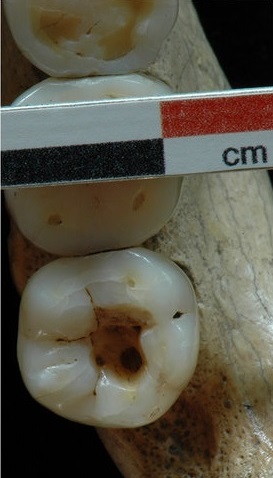 starověký dentistický zákrok, foto Oxilia, Gregorio  et al., Earliest evidence of dental caries manipulation in the Late Upper Palaeolithic, Scientific Reports, 2015/07/16/online, 5, 12150, http://dx.doi.org/10.1038/srep12150, DOI:10.1038/srep12150